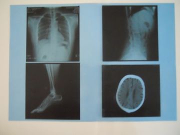 KND-A niedriger Nebel-medizinischer trockener Darstellungs-Film für Prüfung X Ray auf AGFA 5300/5302/5500