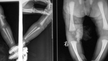 Good price 20 x 25cm medizinische Bildgebung Lasers X Ray, DT1B-/DT2B-Agfa X Ray Film Online