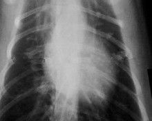 Niedriger Nebel 11 x Papierfilm des röntgenstrahl-14 für medizinische Laserdrucker KND-K