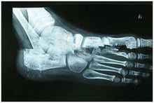 Good price 13in x 17in abbaubare Diagnosedarstellungs-medizinisches Papier X Ray für Laserdrucker Online