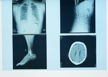 Dauerhafte Diagnosedarstellung X Ray, 32cm x 43cm Film medizinisches Papier-Laser-blauer X Ray