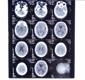 11in * 14in Röntgenstrahl-trockene medizinische Bildgebung filmt KND-A für AGFA 5300, 5302, 5500, 5502, 3000