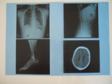 Good price KND-A niedriger Nebel-medizinischer trockener Darstellungs-Film für Prüfung X Ray auf AGFA 5300/5302/5500 Online